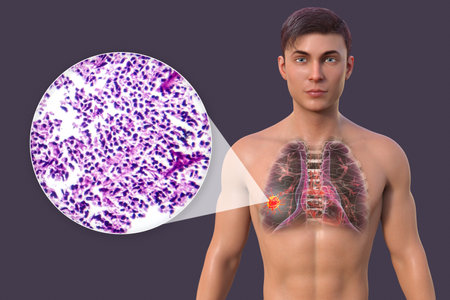 A man with lung cancer, 3D illustration, along with a micrograph image of small cell lung cancer.の写真素材