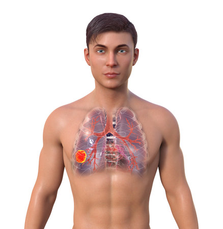 A 3D photorealistic illustration of a man with transparent skin, revealing the presence of lung cancer.の写真素材
