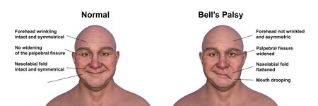 Facial palsy in a man, and the same healthy person, photorealistic 3D illustration highlighting the asymmetry and drooping of the facial muscles on one side of the face.の写真素材