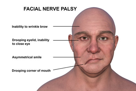 Facial palsy in a man, photorealistic 3D illustration highlighting the asymmetry and drooping of the facial muscles on one side of the face.の写真素材