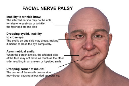 Facial palsy in a man, photorealistic 3D illustration highlighting the asymmetry and drooping of the facial muscles on one side of the face.の写真素材