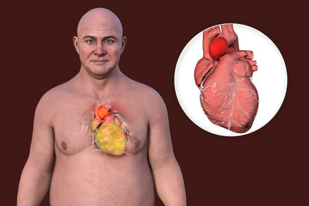 3D illustration of a middle-aged Caucasian man with transparent skin, revealing an obese heart and an ascending aorta aneurysm, highlighting cardiovascular health risks.の写真素材