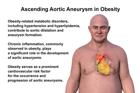 3D illustration of a middle-aged Caucasian man with transparent skin, revealing an obese heart and an ascending aorta aneurysm, highlighting cardiovascular health risks.の写真素材