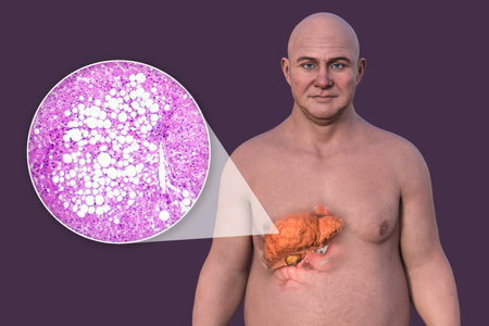 3D illustration of a Caucasian man with transparent skin, revealing a fatty liver, highlighting liver anatomy and fat accumulation, alongside with light micrograph of liver steatosis.の写真素材