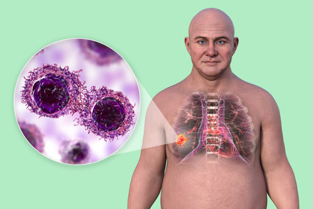 Lung cancer in a middle-aged Caucasian man, 3D illustration showing location and gross anatomy of...