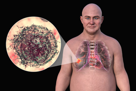Lung cancer in a middle-aged Caucasian man, 3D illustration showing location and gross anatomy of the tumor and morphology of lung cancer cells.の写真素材