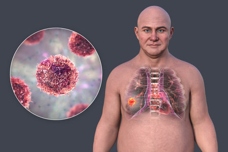 Lung cancer in a middle-aged Caucasian man, 3D illustration showing location and gross anatomy of the tumor and morphology of lung cancer cells.の写真素材