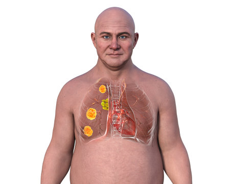 Human lungs affected by blastomycosis, 3D illustration showing fungal infection caused by Blastomyces, highlighting lung nodules and granulomas with characteristic morphology.の写真素材