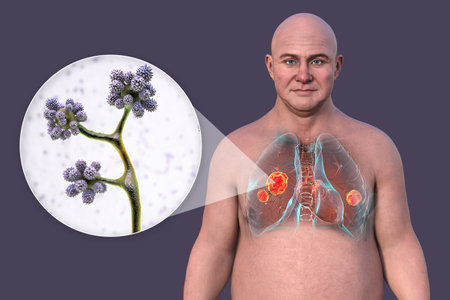 Lung mucormycosis, 3D illustration showing multiple irregular lung nodules and close-up view of Cunninghamella fungi, one of the causative agents of mucormycosis.の写真素材