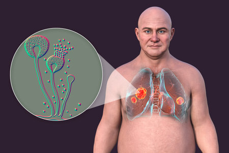 Lung mucormycosis, 3D illustration showing multiple irregular lung nodules and close-up view of Mucor fungi, one of the causative agents of mucormycosis.の写真素材