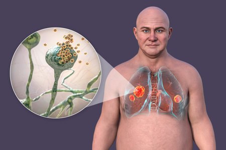 Lung mucormycosis, 3D illustration showing multiple irregular lung nodules and close-up view of Rhizopus fungi, one of the causative agents of mucormycosis.の写真素材