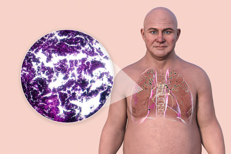 A man with silicosis-affected lungs. 3D illustration and light micrograph showing silicotic nodules and fibrosis, highlighting respiratory health issues from silica exposure.の写真素材