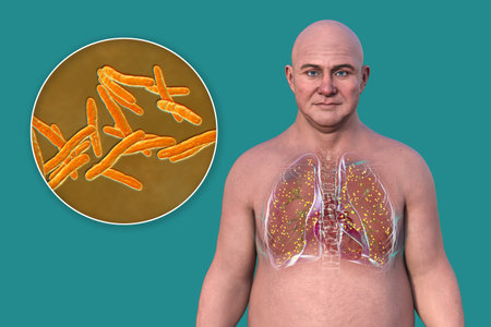 A 3D illustration showcasing a man with transparent skin, revealing the lungs affected by miliary tuberculosis, and close-up view of Mycobacterium tuberculosis bacteria.の写真素材