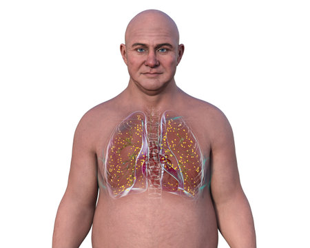 A 3D illustration showcasing a man with transparent skin, revealing the lungs affected by miliary tuberculosis.の写真素材