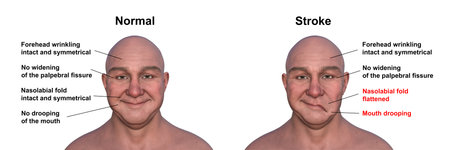 A man showing left-side stroke, with drooping mouth and flat nasolabial fold, and the same healthy person, 3D illustration.の写真素材