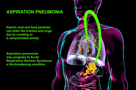 Aspiration pneumonia, conceptual 3D illustration showing gastric acid and food particles entering the trachea and lungs, causing inflammation.の写真素材