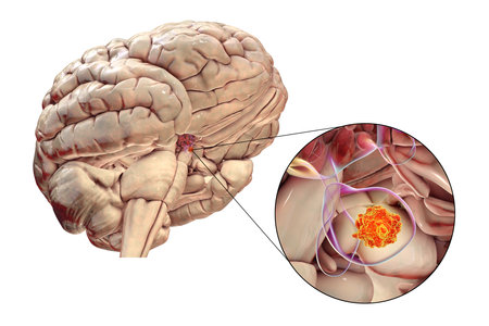 A pituitary gland tumor, 3D medical illustration highlighting its location and impact on nearby structures.の写真素材