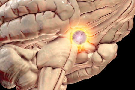 A pituitary gland tumor, 3D medical illustration highlighting its location and impact on nearby structures.の写真素材