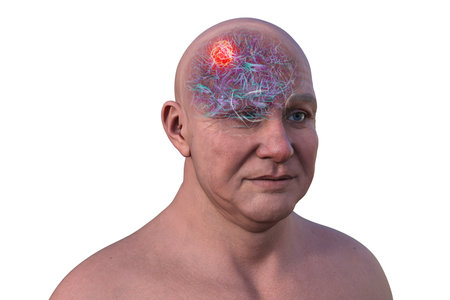 3D illustration of a brain tumor, highlighting its location and structure. Depicts common types such as glioblastoma, meningioma, and astrocytoma.の写真素材