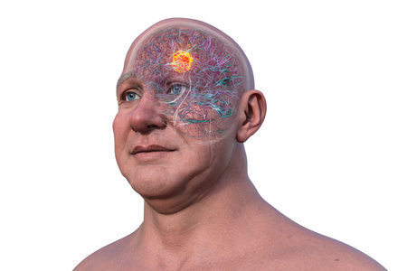 3D illustration of a brain tumor, highlighting its location and structure. Depicts common types such as glioblastoma, meningioma, and astrocytoma.の写真素材