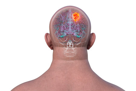 3D illustration of a brain tumor, highlighting its location and structure. Depicts common types such as glioblastoma, meningioma, and astrocytoma, back view.の写真素材