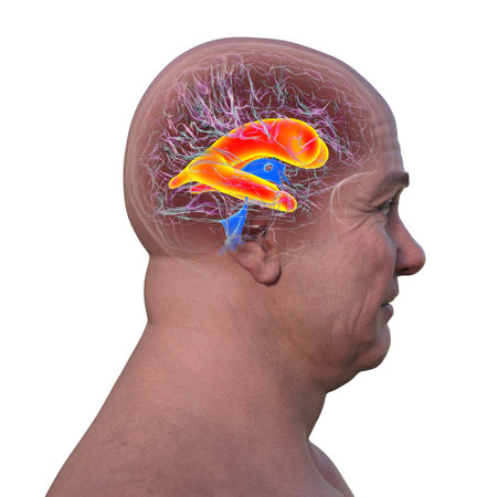 A 3D scientific illustration depicting enlarged lateral ventricles of the brain (hydrocephalus), side view.の写真素材