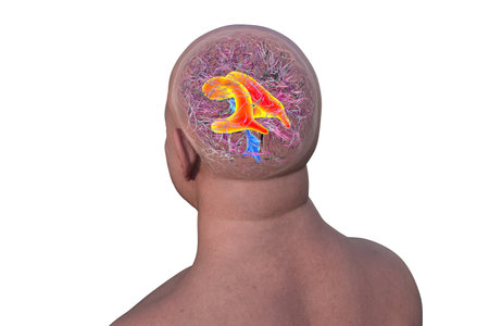 3D illustration showing enlarged lateral ventricles of the brain (hydrocephalus, orange).の写真素材