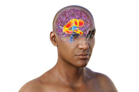 3D illustration showing enlarged lateral ventricles of the brain (hydrocephalus).の写真素材