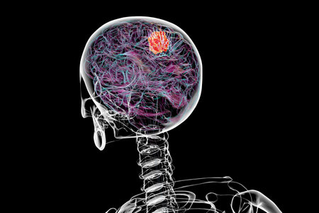 3D illustration of a brain tumor, highlighting its location and structure. Depicts common types such as glioblastoma, meningioma, and astrocytoma for educational and medical purposes.の写真素材