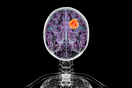 3D illustration of a brain tumor, highlighting its location and structure. Depicts common types such as glioblastoma, meningioma, and astrocytoma for educational and medical purposes.の写真素材