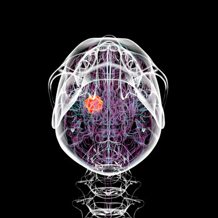 3D illustration of a brain tumor, highlighting its location and structure. Depicts common types such as glioblastoma, meningioma, and astrocytoma for educational and medical purposes, bottom view.の写真素材