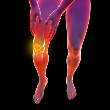 Patella multifragmented displaced fracture, 3D illustration showing multiple broken kneecap fragments misaligned, impairing knee stability and function.の写真素材