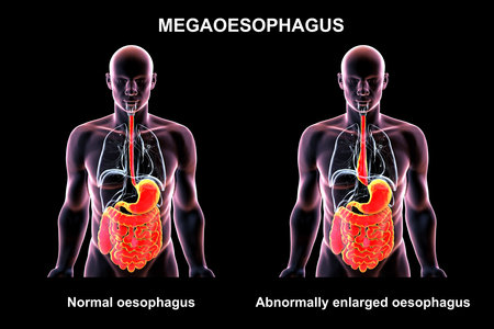 Megaesophagus, 3D illustration showing dilated esophagus. Occurs in achalasia, Chagas disease, scleroderma, esophageal cancer, or chronic obstruction.の写真素材