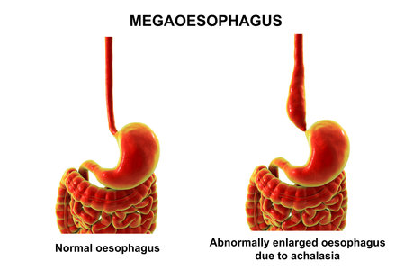 Megaesophagus, 3D illustration showing dilated esophagus. Occurs in achalasia, Chagas disease, scleroderma, esophageal cancer, or chronic obstruction.の写真素材