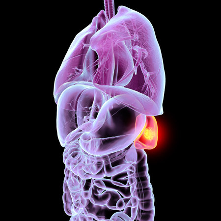 Spleen cancer, 3D illustration showing malignant growth in the spleen, affecting blood filtration and immune function.の写真素材
