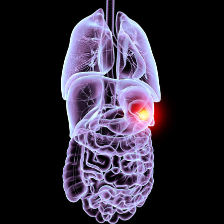 3D illustration showing malignant growth in the spleen, affecting blood filtration and immune function.の写真素材