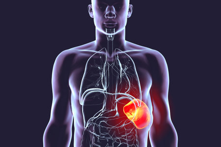 Splenomegaly, 3D illustration showing enlarged spleen. Occurs in infections, liver cirrhosis, leukemia, lymphoma, malaria, and autoimmune diseases.の写真素材