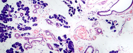 Mixed parotid tumor, photomicrograph showing epithelial and myoepithelial cell components within...