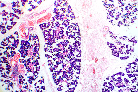 Mixed parotid tumor, photomicrograph showing epithelial and myoepithelial cell components within...