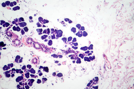 Mixed parotid tumor, photomicrograph showing epithelial and myoepithelial cell components within chondromyxoid stroma, typical of pleomorphic adenoma.の写真素材