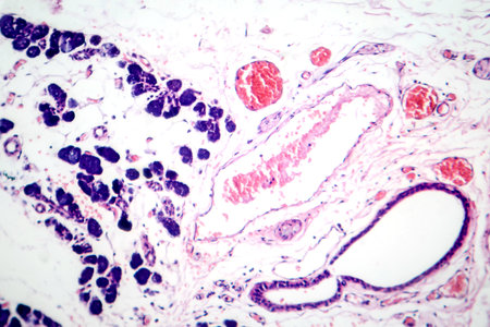 Mixed parotid tumor, photomicrograph showing epithelial and myoepithelial cell components within chondromyxoid stroma, typical of pleomorphic adenoma.の写真素材