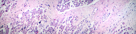 Skeletal muscle atrophy, photomicrograph showing decreased fiber size with increased spacing between them, reduced myofibrils, increased endomysial connective tissue with fatty infiltration.の写真素材