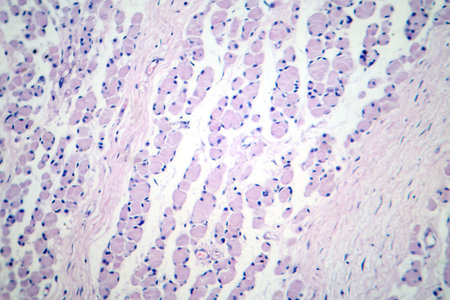 Skeletal muscle atrophy, photomicrograph showing decreased fiber size with increased spacing between them, reduced myofibrils, increased endomysial connective tissue with fatty infiltration.の写真素材
