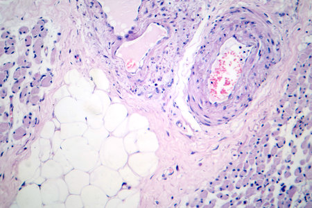 Skeletal muscle atrophy, photomicrograph showing decreased fiber size with increased spacing between them, reduced myofibrils, increased endomysial connective tissue with fatty infiltration.の写真素材