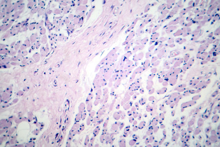 Skeletal muscle atrophy, photomicrograph showing decreased fiber size with increased spacing between them, reduced myofibrils, increased endomysial connective tissue with fatty infiltration.の写真素材