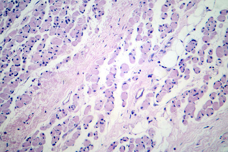 Skeletal muscle atrophy, photomicrograph showing decreased fiber size with increased spacing between them, reduced myofibrils, increased endomysial connective tissue with fatty infiltration.の写真素材