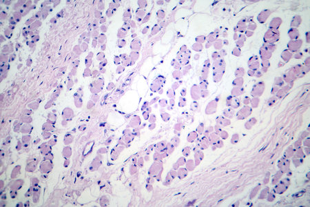 Skeletal muscle atrophy, photomicrograph showing decreased fiber size with increased spacing between them, reduced myofibrils, increased endomysial connective tissue with fatty infiltration.の写真素材