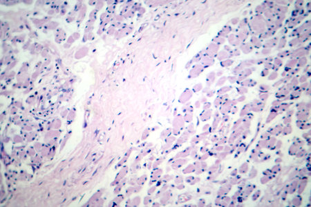 Skeletal muscle atrophy, photomicrograph showing decreased fiber size with increased spacing between them, reduced myofibrils, increased endomysial connective tissue with fatty infiltration.の写真素材
