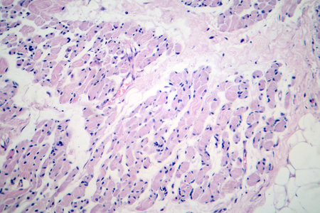 Skeletal muscle atrophy, photomicrograph showing decreased fiber size with increased spacing between them, reduced myofibrils, increased endomysial connective tissue with fatty infiltration.の写真素材