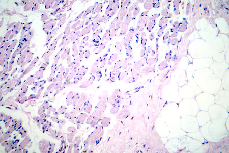Skeletal muscle atrophy, photomicrograph showing decreased fiber size with increased spacing between them, reduced myofibrils, increased endomysial connective tissue with fatty infiltration.の写真素材